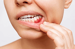 Zahnfleischerkrankungen